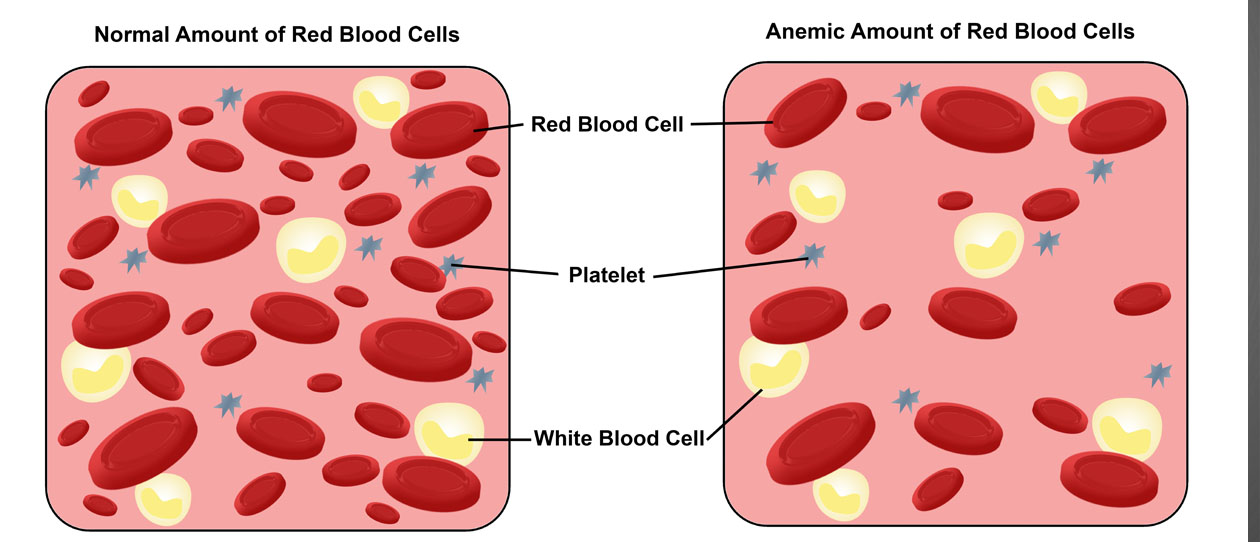 Anaemia